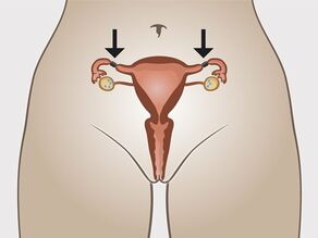 Sterilization for women: the fallopian tubes are blocked.