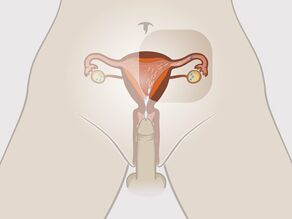 Un homme éjacule dans le vagin de la femme. Les spermatozoïdes nagent vers l’ovule mature.