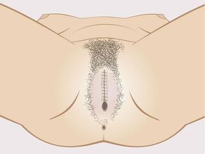 Kvinnelig kjønnslemlestelse – type 3: Kjønnsleppene sys sammen.