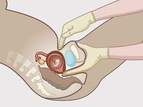 Vaginal undersøkelse i detalj: Legen fører et par fingre inn i skjeden for å kjenne om livmormunnen allerede har åpnet seg. Han/hun sjekker også livmorens posisjon fra utsiden.