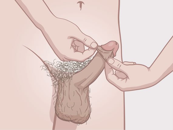 Omskåret penis