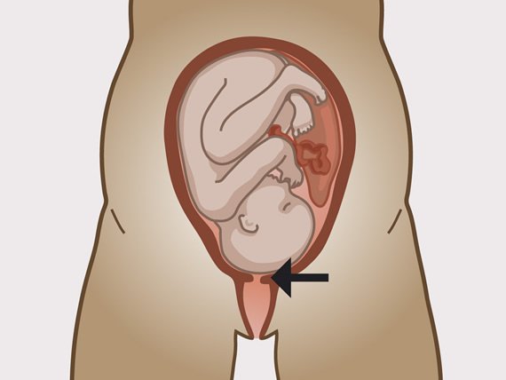 L'evolution du ventre en post accouchement 💚🍼 On en parle Code JAJ
