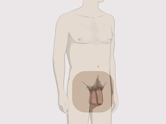 Penis omskåret Omskåret penis