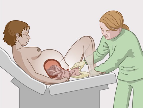 En kvinne føder en baby